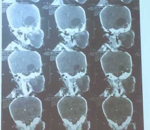 Bướu quái chứa xương và tóc hiếm gặp ở bé gái 20 ngày tuổi