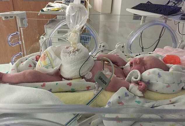 Em bé sinh ra với dạ dày, ruột, buồng trứng nằm ngoài bụng