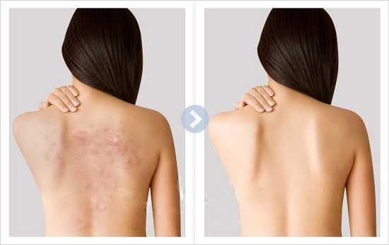 Vì sao lưng bạn lại mọc mụn?