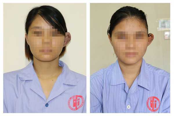 Phẫu thuật thành công cho thiếu nữ Đất Mỏ có một bên tai to bất thường