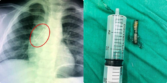 Mở quả trứng đồ chơi, bé trai bị lò xo bắn vào phổi