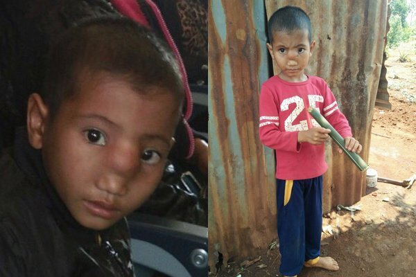 Căn bệnh kỳ lạ khiến cậu bé bị tụt não xuống mũi