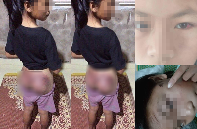 Video: Bé gái 12 tuổi bị công an viên đánh bầm tím