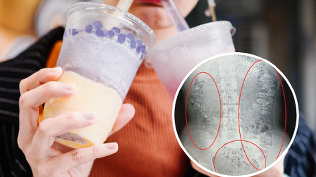 Nghiện trà sữa, bé gái 14 tuổi bị hàng trăm hạt trân châu làm tắc ruột