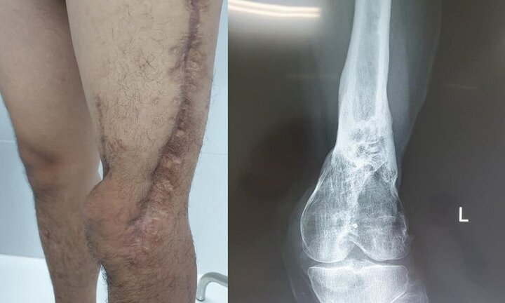 Lần đầu ghép cơ phục hồi chân cho nạn nhân bị tai nạn giao thông