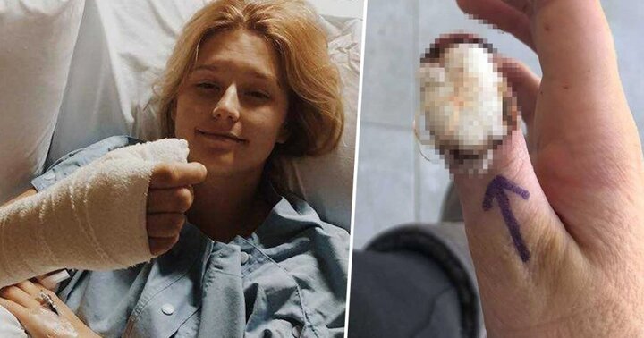 Video: Cô gái phải cắt bỏ ngón tay vì thói quen cắn móng tay