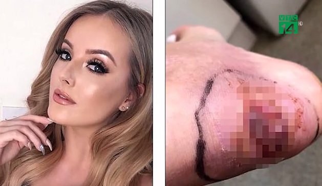 Video: Đi dép quai hậu, nữ người mẫu suýt phải cắt chân
