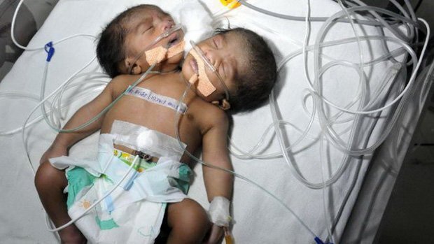 Từ chối bỏ thai dị tật, bà mẹ sinh em bé hai đầu ở Ukraine