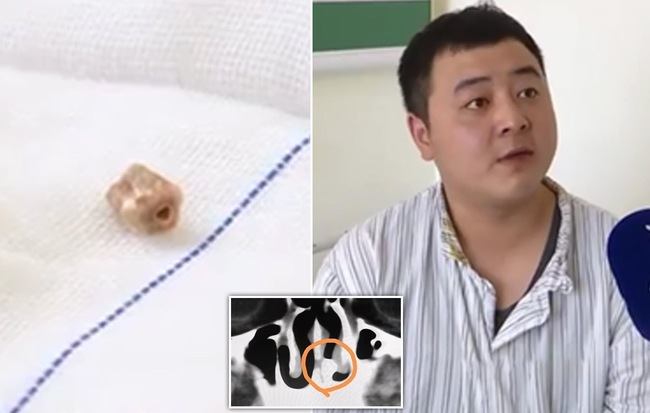 Chàng trai có răng trong mũi 20 năm không hề hay biết