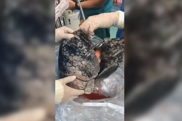 Video: Bộ phổi đen sì của người nghiện thuốc lá