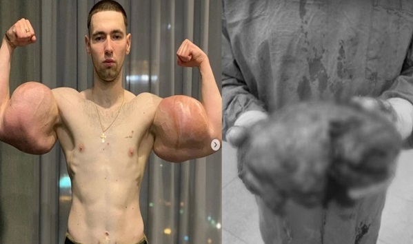 Video: Bơm 3 lít dầu vào tay, vận động viên thể hình bị thối hết cơ bắp