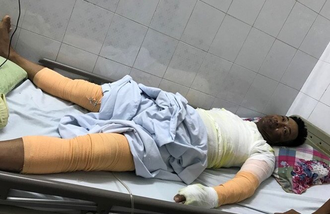 Nổ bình gas, một người đàn ông cháy sém mặt, bỏng toàn thân