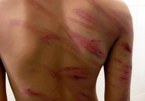 Bé trai 8 tuổi bị cha dượng đánh rướm máu