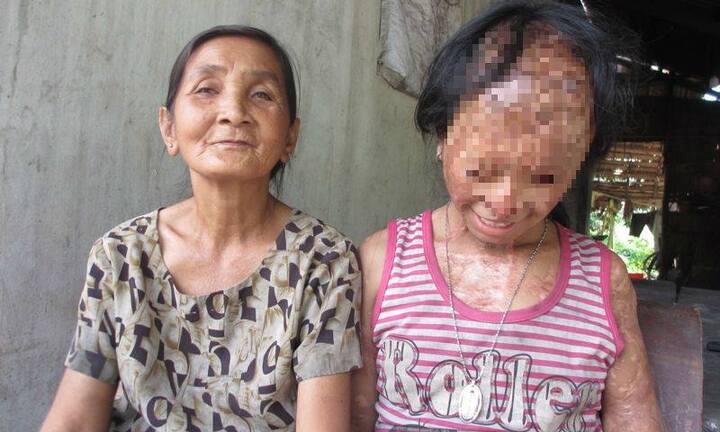 Xót xa chuyện bà nội bé gái bị tạt axit, lặn lội lên TP.HCM xin đôi mắt của tử tù cho cháu