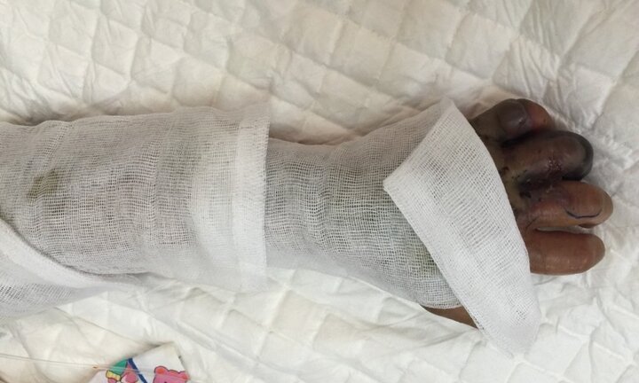 Đắp lá thuốc chữa rắn hổ đất cắn, bệnh nhi 10 tuổi hoại tử bàn tay thối thịt