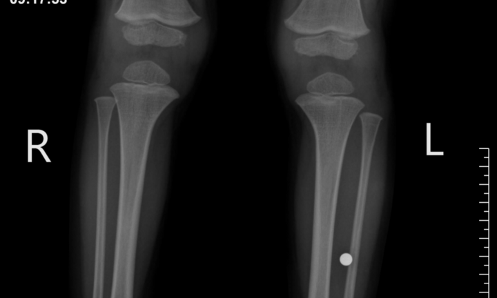 Hoảng loạn khi phát hiện viên bi đồ chơi trong chân bé trai 3 tuổi