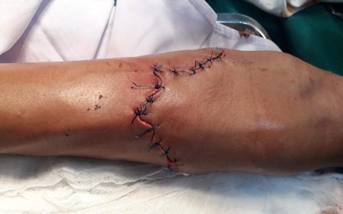 Tấm tôn cắt sâu vào tay, nam thanh niên 31 tuổi mất cả lít máu, lộ xương