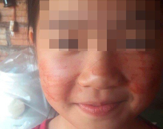 Bé 11 tuổi ra mồ hôi máu: Mồ hôi máu là gì, nguyên nhân mồ hôi đỏ như máu?