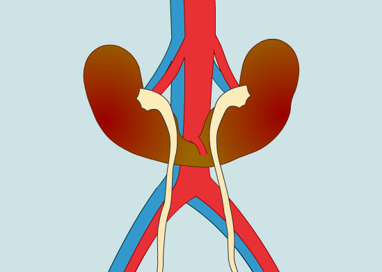 Mắc bệnh thận móng ngựa hiếm gặp, hai quả thận của người đàn ông đầy mủ, ứ nước