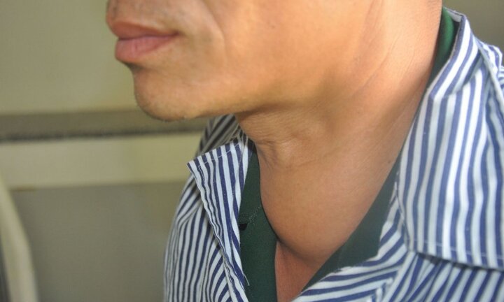 Bác sỹ hút hơn cả lít dịch trong khối u tuyến giáp của bệnh nhân