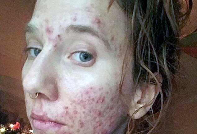 Thực hư uống nước tiểu có thể giảm cân, giúp da láng mịn hay gây suy thận?