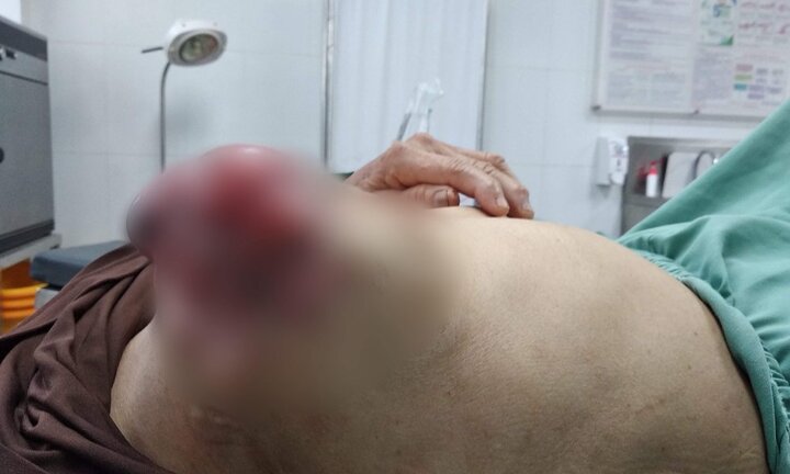 Mù quáng đắp lá chữa ung thư vú, người phụ nữ vỡ loét khối u, nguy hiểm tính mạng