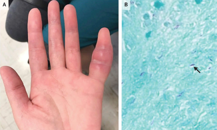 Đột nhiên sưng tay, đi khám mới biết nhiễm bệnh nguy hiểm chết người