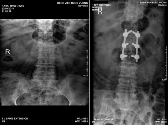 Tai nạn vỡ đốt sống lưng, người phụ nữ 65 tuổi suýt tàn phế suốt đời được cứu