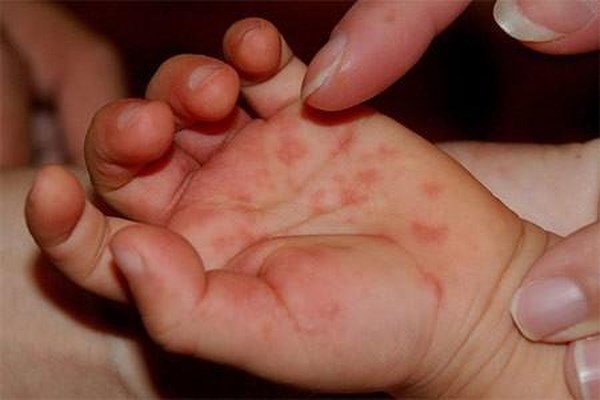 Căn bệnh khiến 47.500 trẻ mắc năm 2018 nguy hiểm cỡ nào?