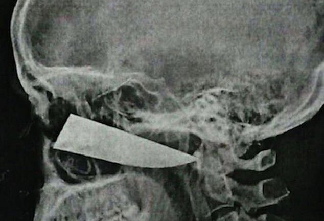 Xô xát trong quán rượu, nam thanh niên bị dao đâm sâu vào sọ mà không biết