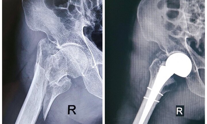 Phẫu thuật thay khớp háng cho cụ ông 96 tuổi, mang trong mình cả ‘núi bệnh’