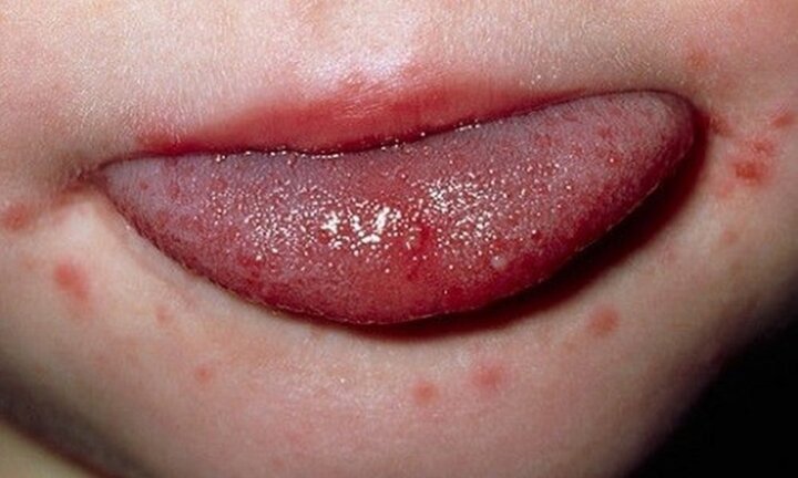 Chuyên gia chỉ cách phân biệt bệnh tay chân miệng với các bệnh khác?