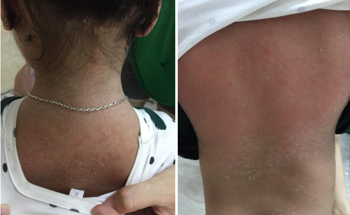 Mắc hội chứng lạ, bé gái 3 tuổi bong tróc da toàn thân như da rắn
