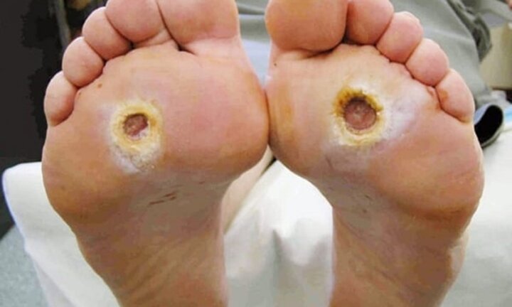 Kẻ giết người thầm lặng này dễ gây biến chứng mù lòa, suy thận, nhồi máu cơ tim