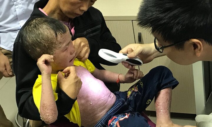 Tiếng khóc xé lòng của bé trai 5 tuổi mắc bệnh khó chữa, nổi mụn mưng mủ toàn thân