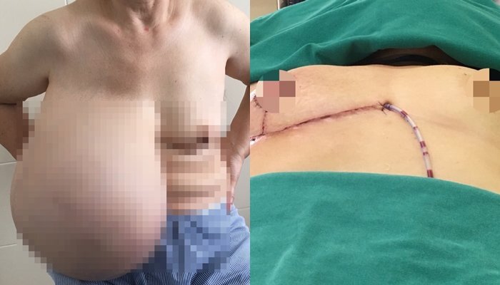 Lấy thành công khối u vú nặng gần 9kg ra khỏi ngực người phụ nữ 64 tuổi