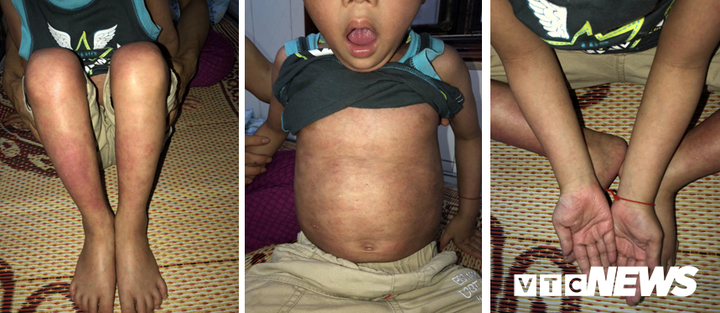 Hồi phục kỳ diệu, bé trai 5 tuổi ở Cao Bằng mắc bệnh khó chữa vừa được ra viện