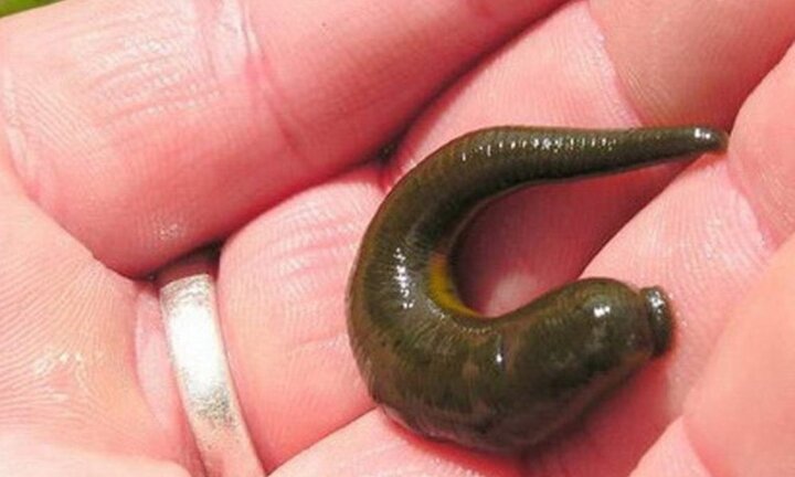 Kinh hoàng đỉa dài 5cm mắc kẹt trong đường thở bé gái 9 tuổi