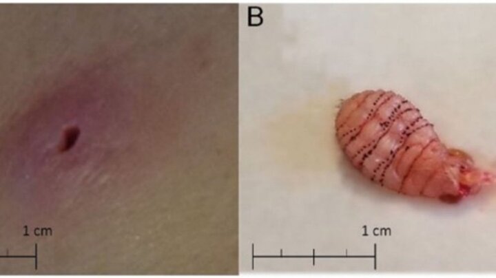 Đi trăng mật về, người phụ nữ bị ấu trùng ruồi làm tổ dưới da