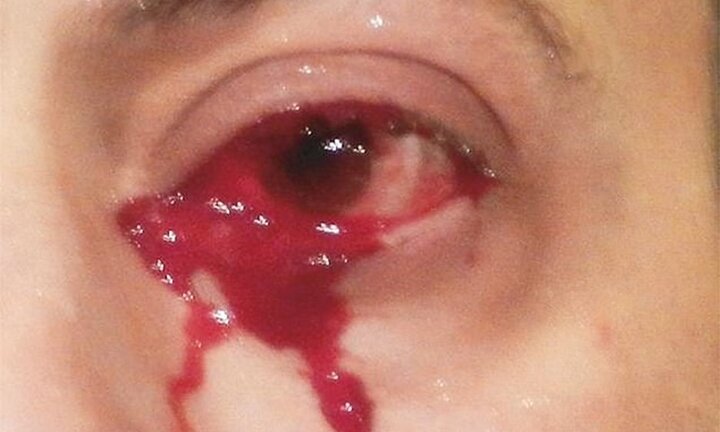 Căn bệnh lạ khiến người đàn ông 52 tuổi liên tục khóc ra máu