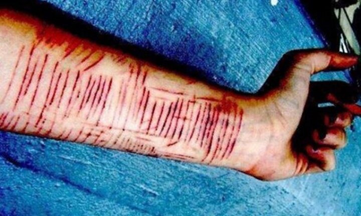 Bệnh khiến ca sĩ Hương Tràm tự bóc da tay đến rỉ máu không hiếm trong giới trẻ