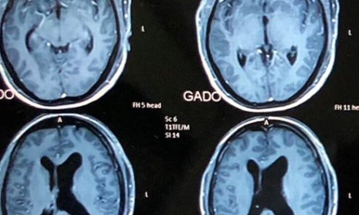 Cứu sống ngoạn mục người đàn ông có khối u khổng lồ trong não