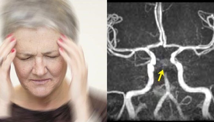 Nếu không muốn thiệt mạng thì đừng ‘khinh thường’ rối loạn tiền đình