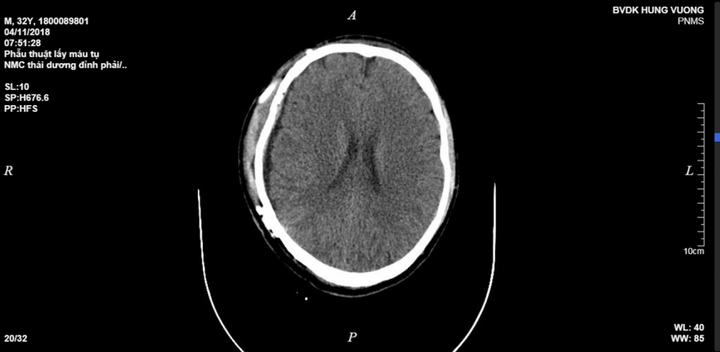 Ngã từ độ cao 3 mét, người đàn ông 32 tuổi tụ máu não suýt chết