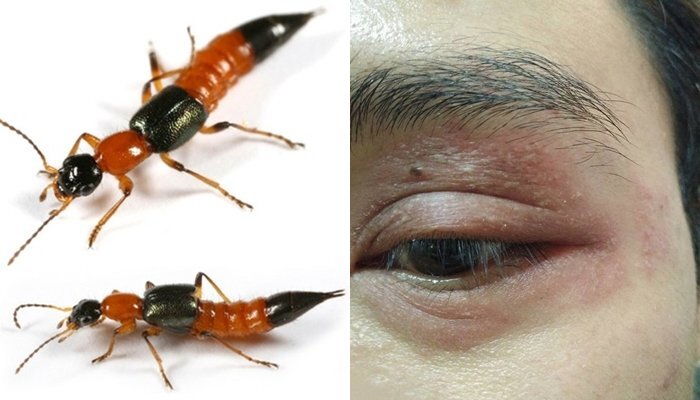 Làm điều này khi gặp kiến ba khoang, nhiều người sưng húp, phồng rộp mặt mày