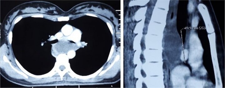 Kỳ lạ: Người phụ nữ ‘có kén’ trong phế quản
