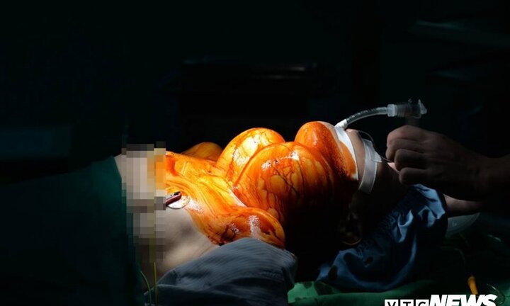 Người phụ nữ 47 tuổi mang khối u giáp nặng ‘trĩu cổ’