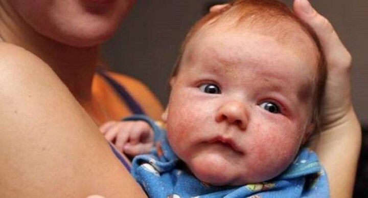 Chuyên gia nước ngoài chỉ 6 mẹo chống viêm da dị ứng cho trẻ sơ sinh