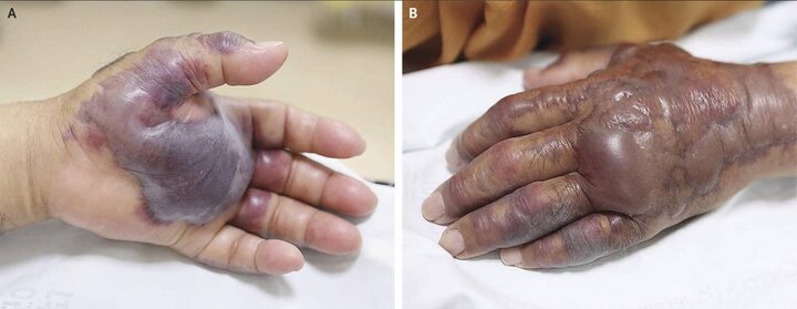 Ăn hàu sống, một người đàn ông phải cắt cụt cả bàn tay