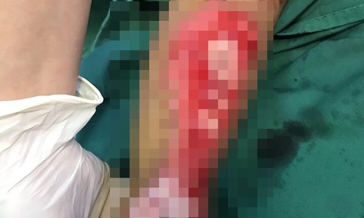 Đùa nghịch cho chân vào bánh xe đang chạy, bé 2 tuổi bị đứt gân, lộ xương gót chân